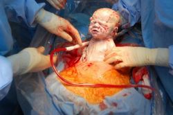 Caesarean section